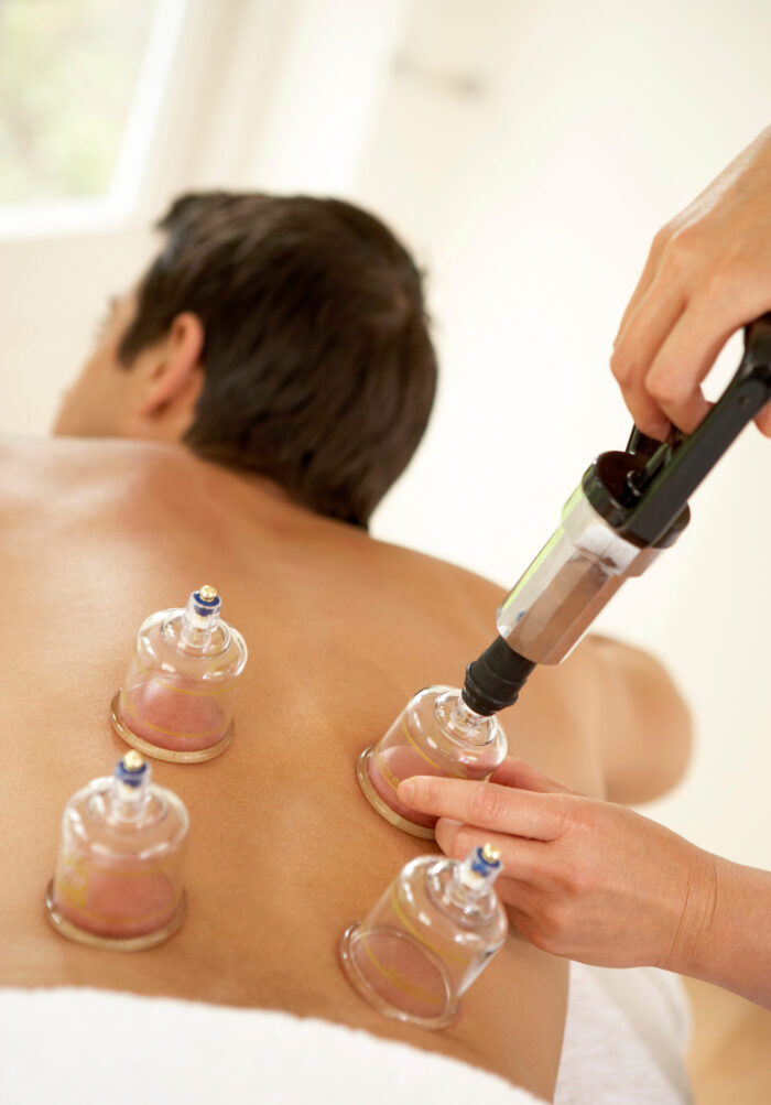 Back view of a person receiving cupping therapy: glass cups placed on the back, with a practitioner using a device on one cup.