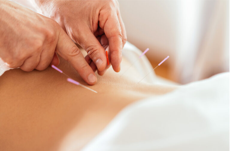 Acupuncture session: a practitioner inserts thin needles into a person's upper back